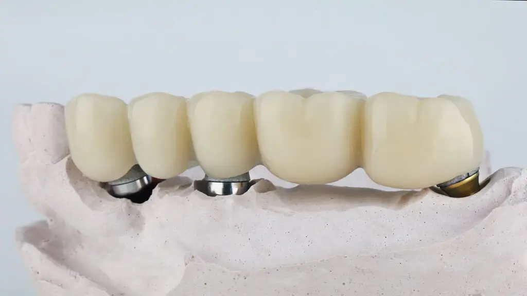 What Makes Implant Bridges a Smart Option for Several Missing Teeth?