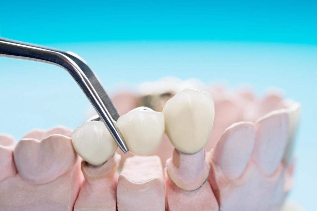 A dental bridge held by tweezers above a dental model.