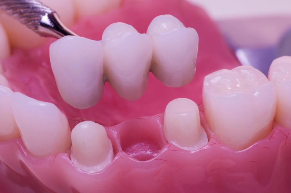 A dental bridge being fitted onto a model with prepared teeth and a missing tooth gap.